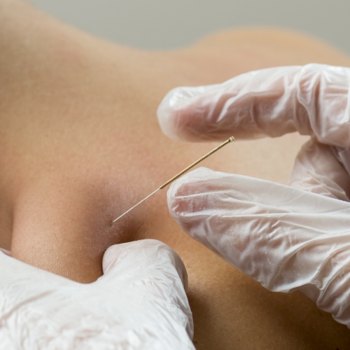 physical-therapy-clinic-dry-needling-kinect-physiotherapy-knightdale-wake-forest-nc
