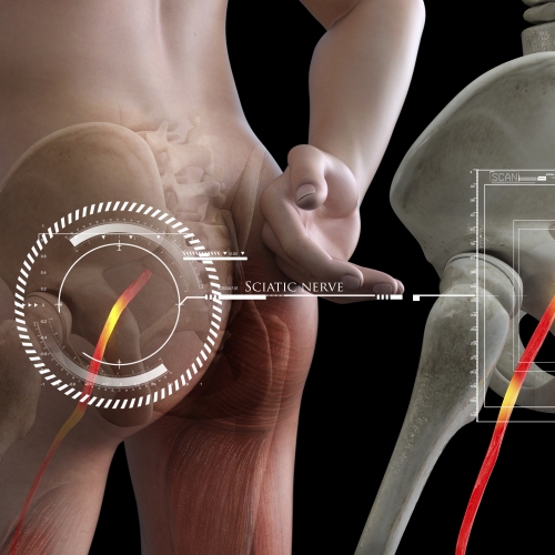 Sciatica Relief Wake Forest & Knightdale - Kinect Physiotherapy
